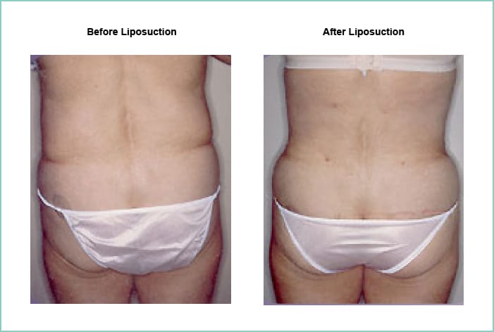 Liposuction Before and After #9