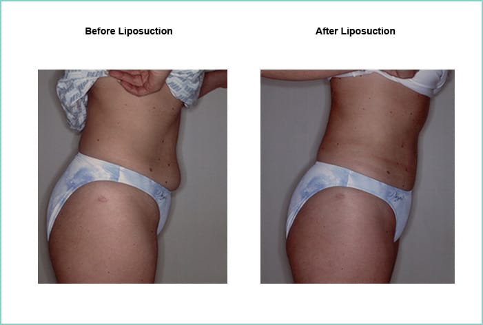 Liposuction Before and After #2