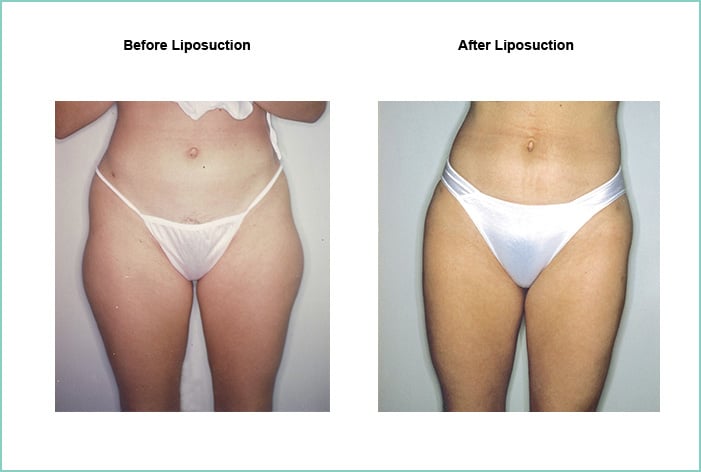 Liposuction Before and After #6
