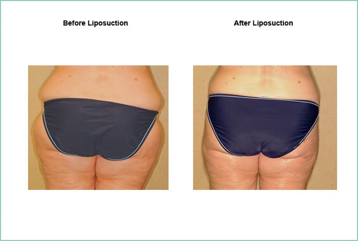 Liposuction Before and After #8