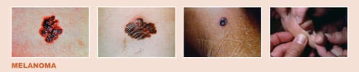 examples of Melanoma skin cancer