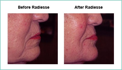 radiesse before and after 1