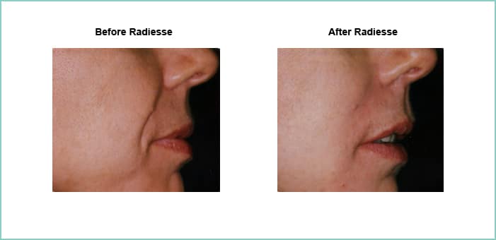 radiesse before and after 2