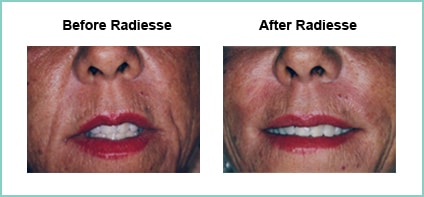 radiesse before and after 3