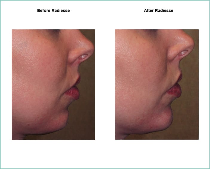 radiesse before and after 4