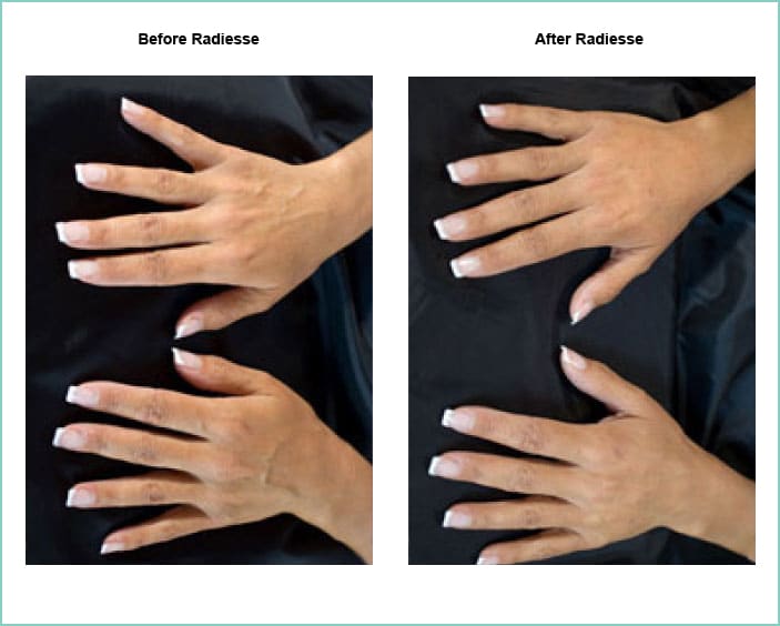 radiesse before and after 5