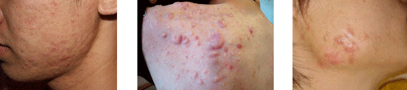 raised acne scars