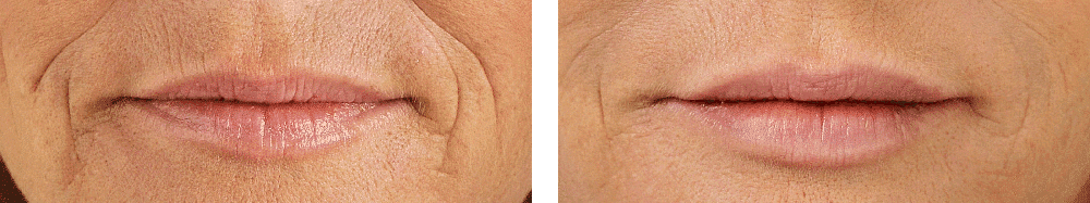 restylane before and after 1