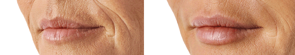 restylane before and after 1