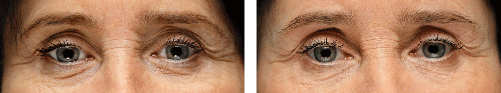 restylane before and after 1