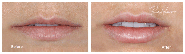 restylane before and after 1