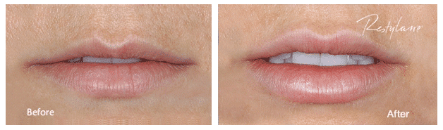restylane before and after 1
