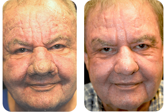male before and after Rhinophyma procedure