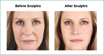 sculptra before and after 1