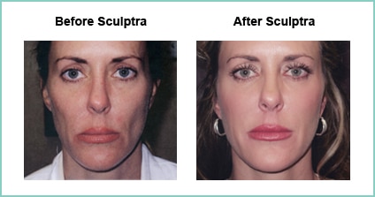 sculptra before and after 2