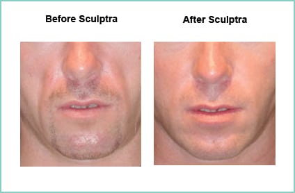 sculptra before and after 3