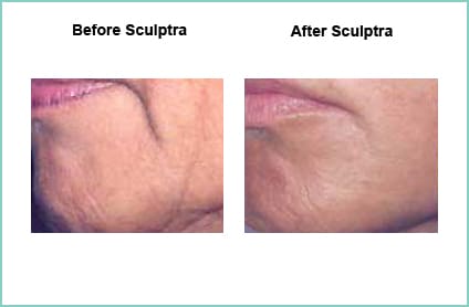 sculptra before and after 4