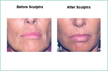 sculptra before and after 5