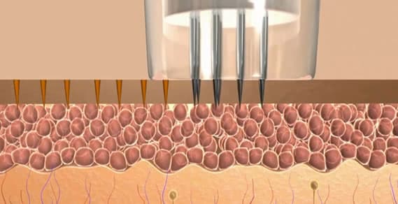 microneedly on skin animation