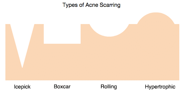 diagram of the different type of acne scarring