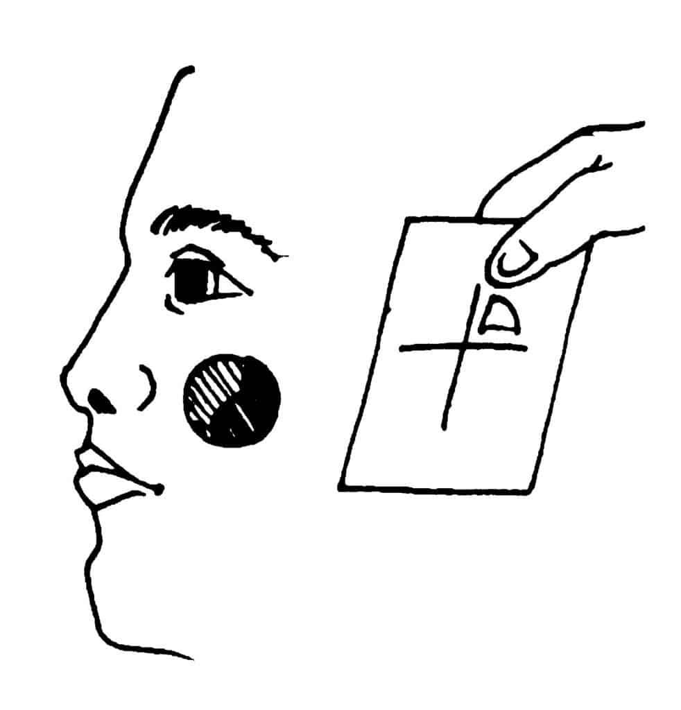 Mohs procedure figure E