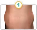 CoolSculpting stomach image one.