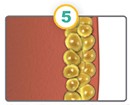 CoolSculpting condensed fat cells diagram.