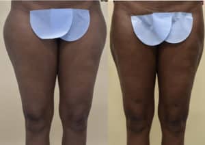 lipo before and after