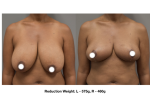 A third before and after breast augmentation surgery comparison image.