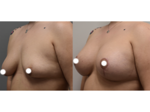 A before and after breast augmentation surgery comparison image.