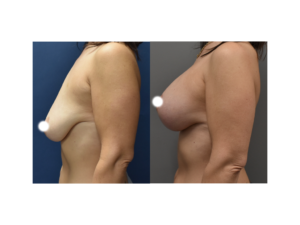 Another before and after breast augmentation surgery comparison image.