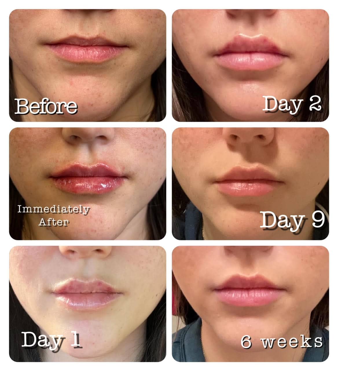 Lip filler swelling stages before and after across a 6-week period