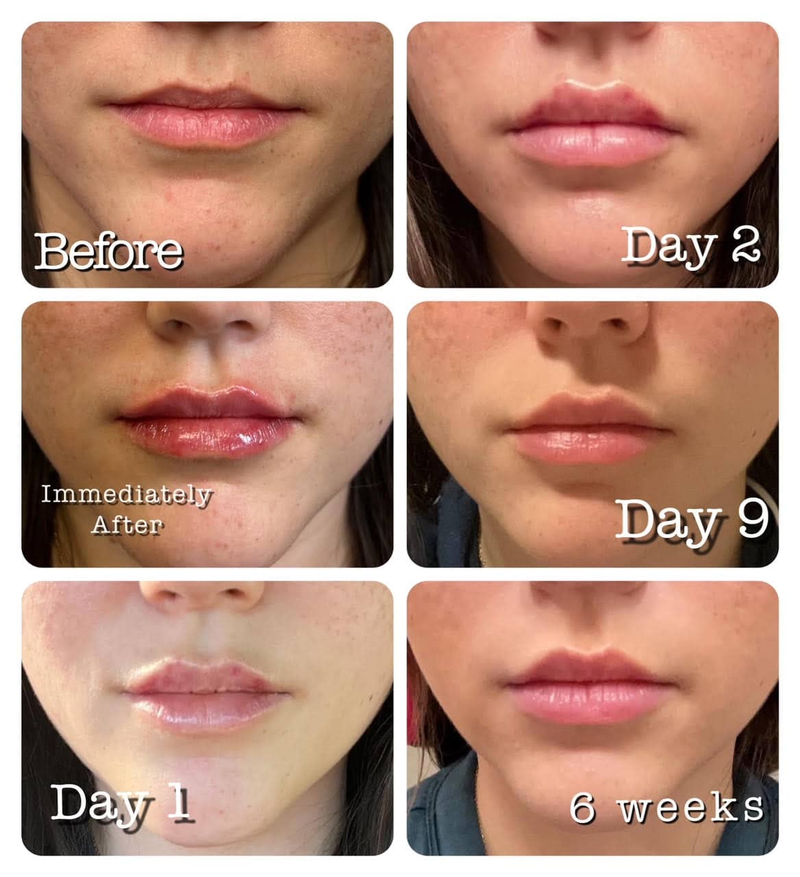 Lip Filler Shapes 